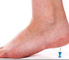 Plantar Fasciitis